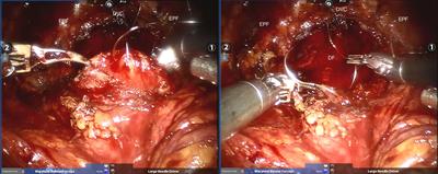 Application of anatomic reconstruction technique for periurethral structure in robotic assisted laparoscopic radical prostatectomy